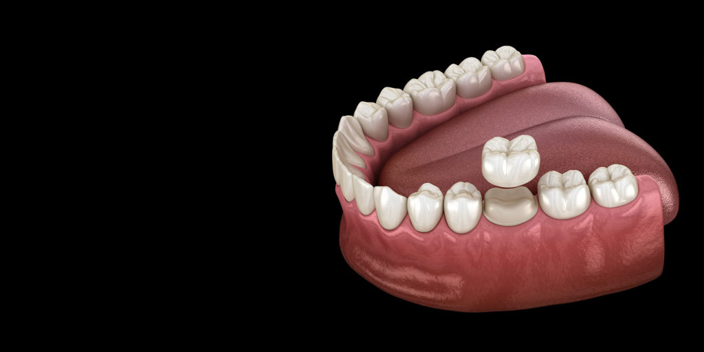 Dental crown example model black background