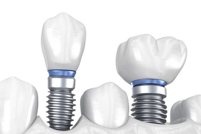 Dental implant white background