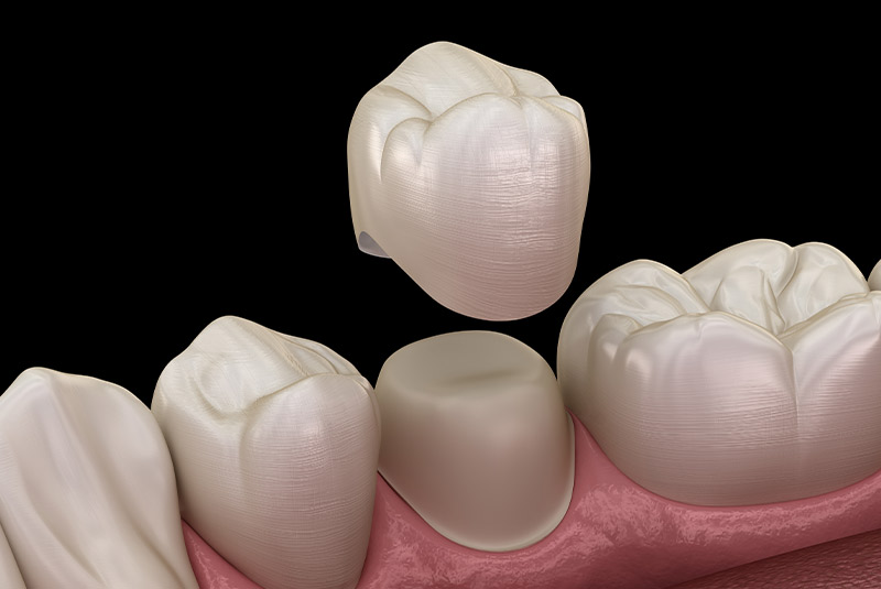 Dental crown example model